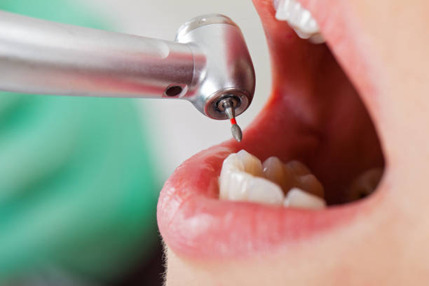 Best Emergency Tooth Extraction in Preston, IA